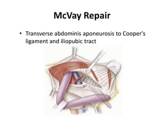 McVay Repair
• Transverse abdominis aponeurosis to Cooper's
  ligament and iliopubic tract
 