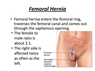 Femoral Hernia
• Femoral hernia enters the femoral ring,
   traverses the femoral canal and comes out
   through the saphenous opening.
 • The female to
   male ratio is
   about 2:1.
 • The right side is
   affected twice
   as often as the
   left.
 