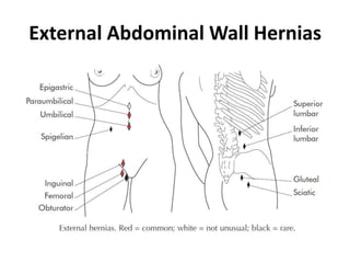 External Abdominal Wall Hernias
 