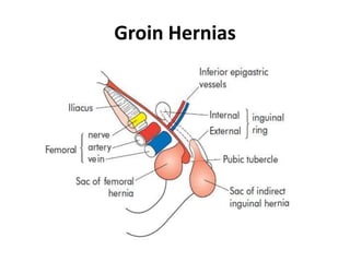Groin Hernias
 