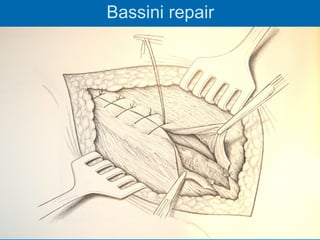 Bassini repair
 