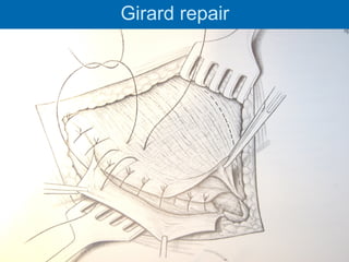 Girard repair
 