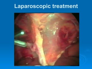 Laparoscopic treatment
 