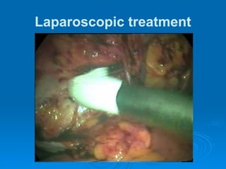 Laparoscopic treatment
 