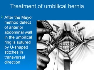Treatment of umbilical hernia
 After the Meyo
method defect
of anterior
abdominal wall
in the umbilical
ring is sutured
by U-shaped
stitches in
transversal
direction
 