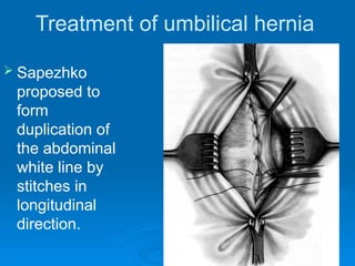Treatment of umbilical hernia
 Sapezhko
proposed to
form
duplication of
the abdominal
white line by
stitches in
longitudinal
direction.
 