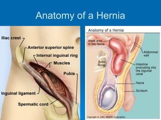 Anatomy of a Hernia
 