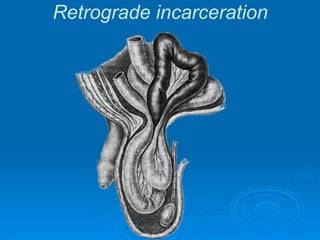 Retrograde incarceration
 