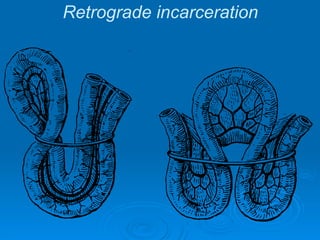 Retrograde incarceration
 