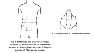 abdominal incision.pptx