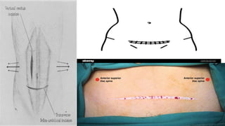 GENERAL ABDOMINAL INCISION FOR PHYSIOTHERAPY | PPTX