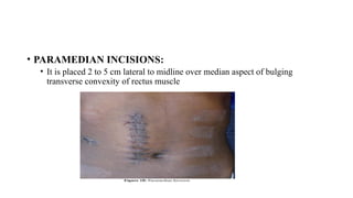 GENERAL ABDOMINAL INCISION FOR PHYSIOTHERAPY | PPTX