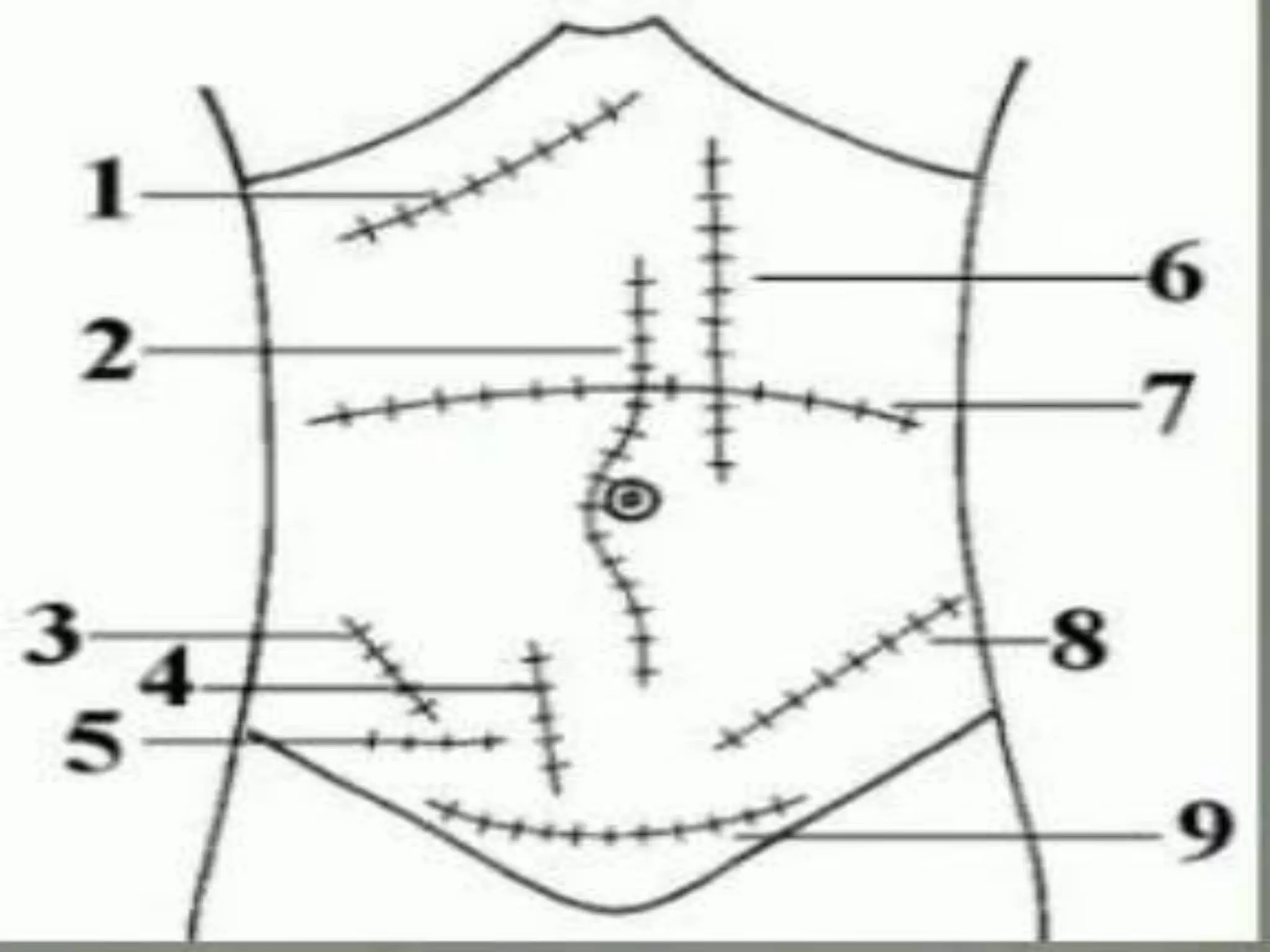 Abdominal incisions | PPTX