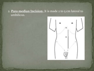 2. Para median Incision- It is made 2 to 5 cm lateral to
umbilicus.
 