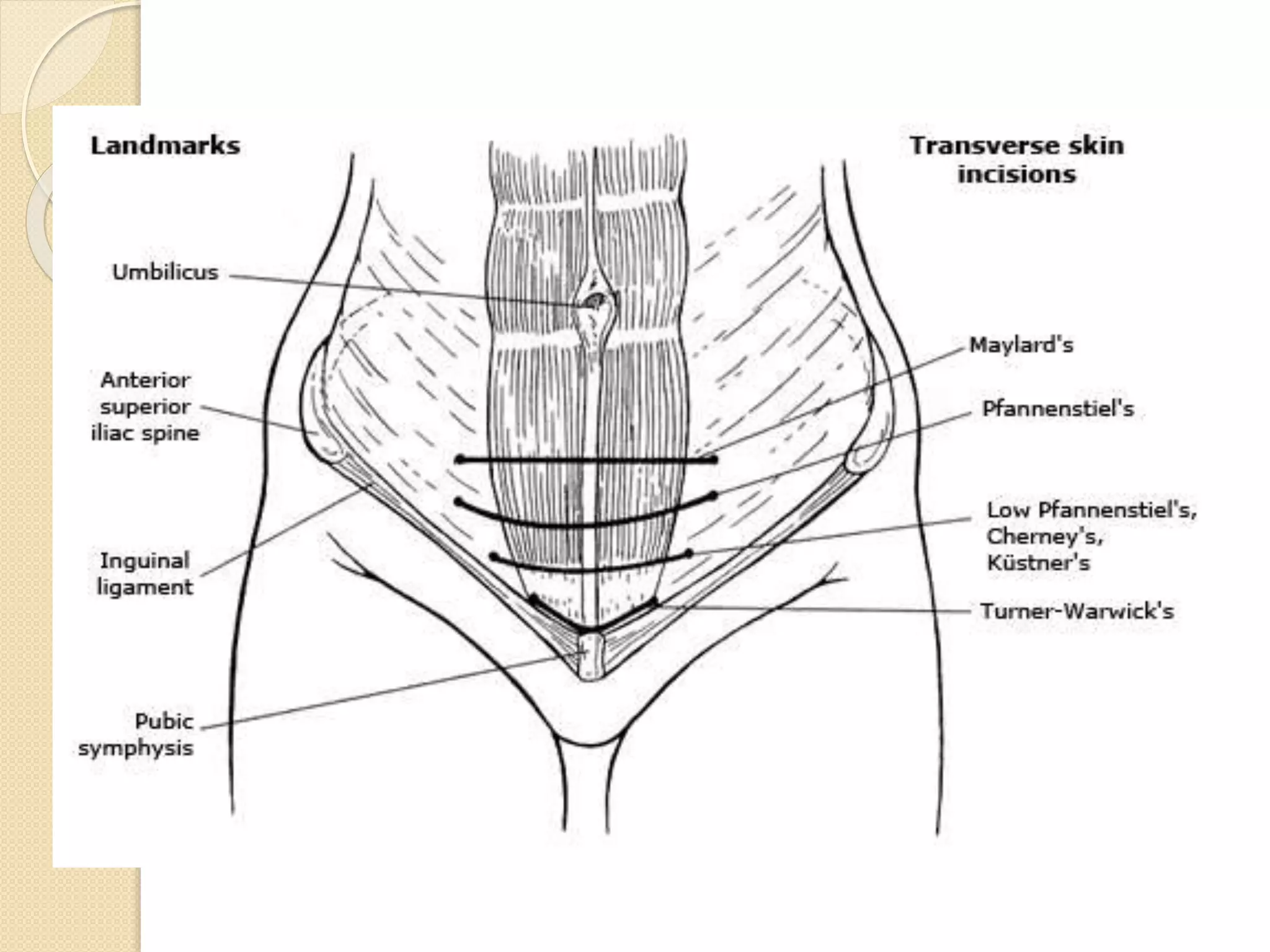 Incision Wikipedia Anatomy Of Abdominal Incisions – XRWPMN