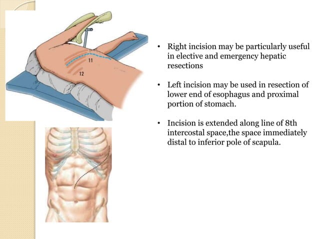 Incision Wikipedia Abdominal incisions | PPTX | Pregnancy | Reproductive Health