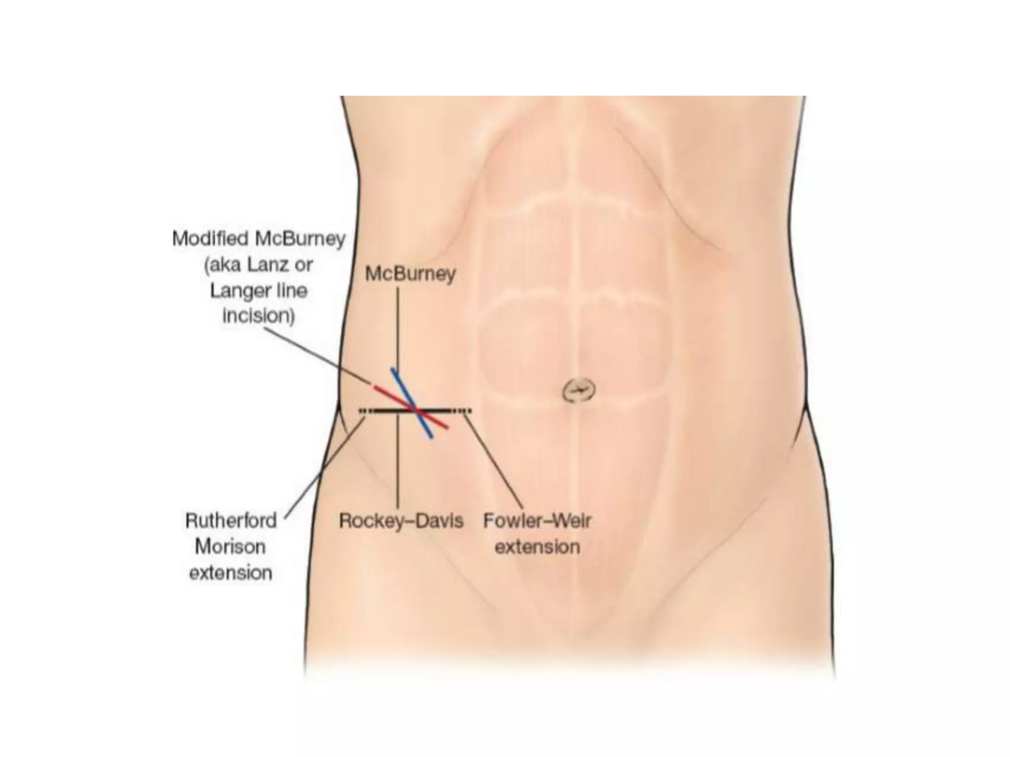 Abdominal wall: incisions and closures | PPTX