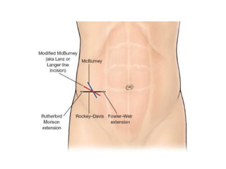 Incision Wikipedia abdominal incisions wall anatomy and other | PDF