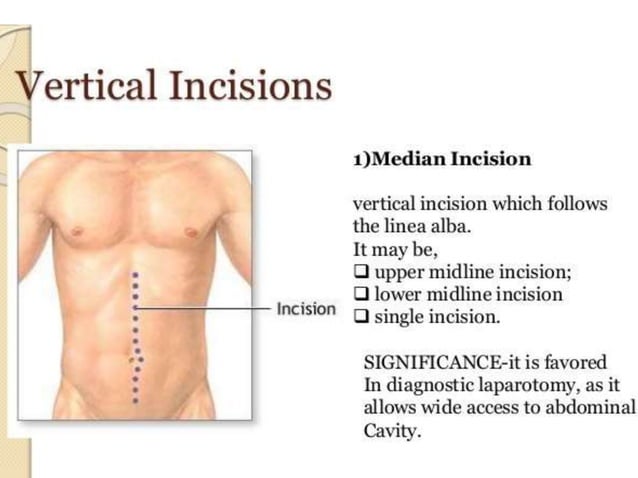 Incision Wikipedia Abdominal incisions | PPTX