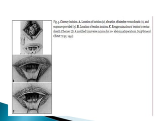 Abdominal incisions | PPTX
