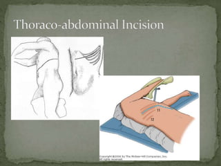 Abdominal incisions