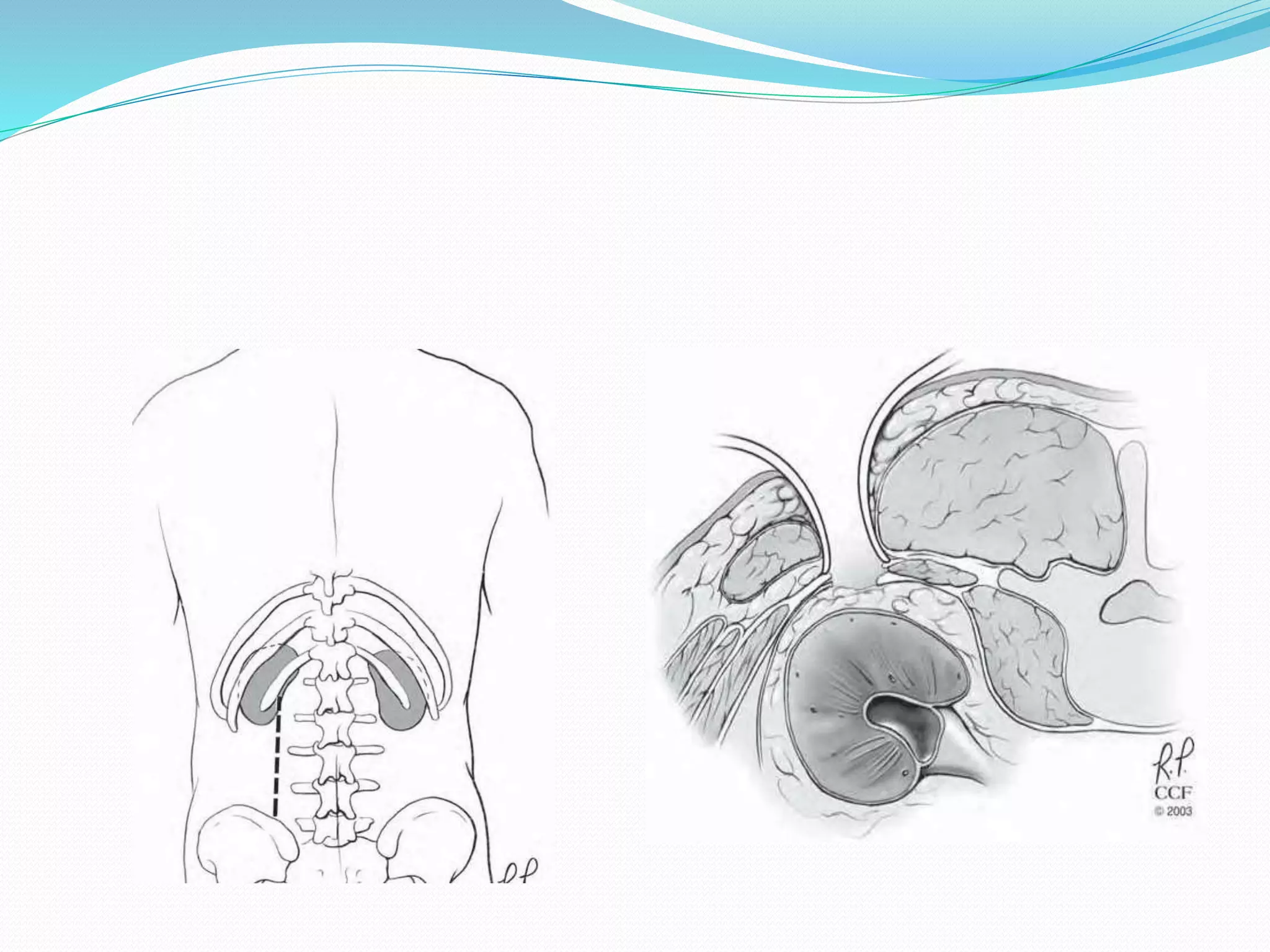 Full Midline Incision abdominal incisions.pptx