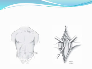 abdominal incisions.pptx