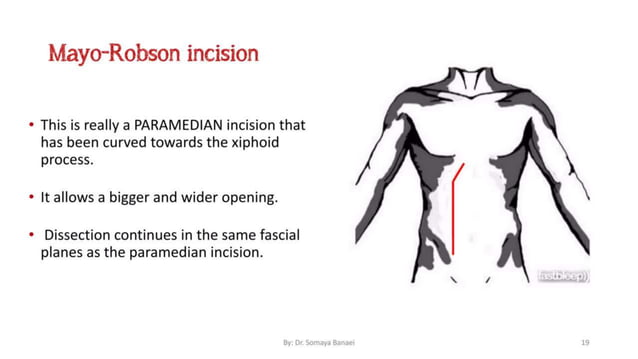 Abdominal Incisions for medical students | PPTX