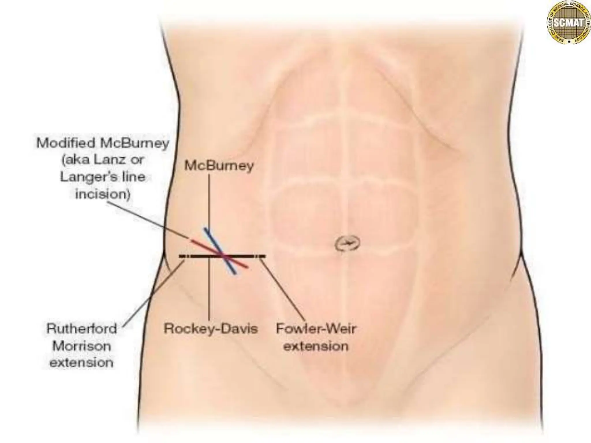 abdominal incisions.pptx