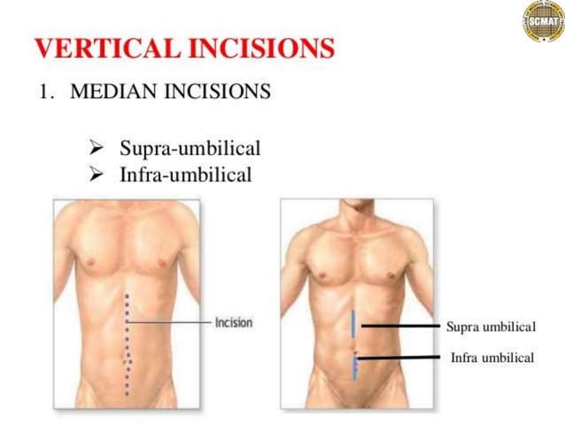 abdominal incisions.pptx