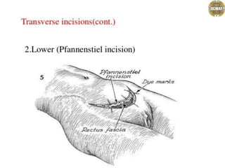 .................abdominal incisions.pptx
