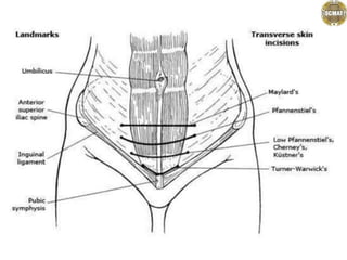 .................abdominal incisions.pptx