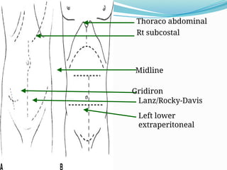 Full Midline Incision ABDOMINAL INCISIONS- DAVID surgical tutorial and lecture.pptx