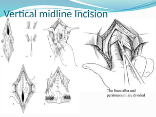 Full Midline Incision ABDOMINAL INCISIONS- DAVID surgical tutorial and lecture.pptx