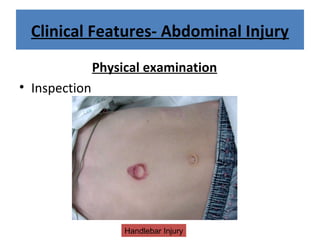Clinical Features- Abdominal Injury
Physical examination
• Inspection
Handlebar Injury
 