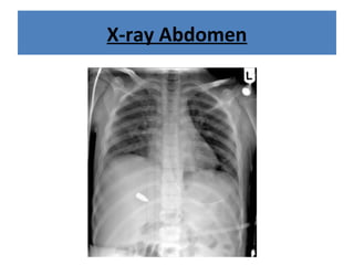 X-ray Abdomen
 
