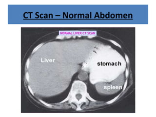 CT Scan – Normal Abdomen
 