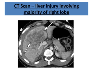 CT Scan – liver injury involving
majority of right lobe
 