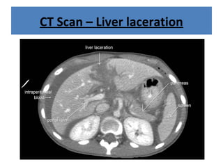 CT Scan – Liver laceration
 