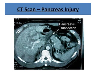 CT Scan – Pancreas Injury
 