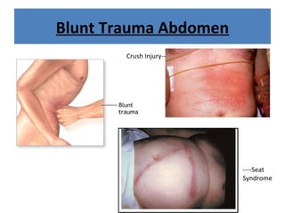 Blunt Trauma Abdomen
----Seat
Syndrome
Crush Injury--
 