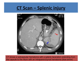 CT Scan – Splenic injury
CT shows a subcapsular hematoma with a splenic laceration extending from
the capsule to the hilum with an intraparenchymal hematoma (blue arrow)
 