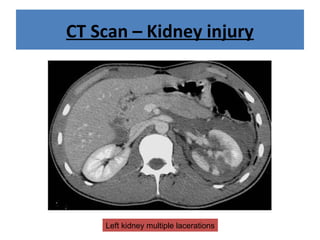 CT Scan – Kidney injury
Left kidney multiple lacerations
 