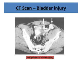 CT Scan – Bladder injury
Intraperitoneal bladder injury
 