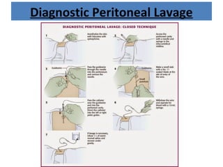 Diagnostic Peritoneal Lavage
 