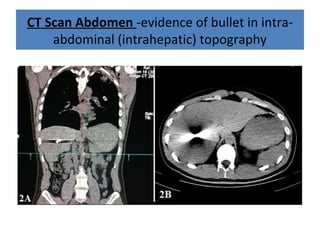 CT Scan Abdomen -evidence of bullet in intra-
abdominal (intrahepatic) topography
 