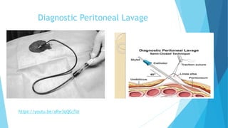 Diagnostic Peritoneal Lavage
https://youtu.be/aRw3qQGjTzI
 