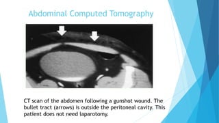 Abdominal Computed Tomography
CT scan of the abdomen following a gunshot wound. The
bullet tract (arrows) is outside the peritoneal cavity. This
patient does not need laparotomy.
 