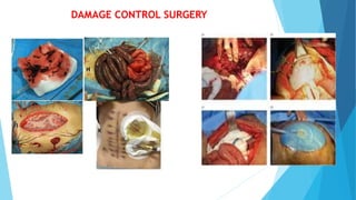 DAMAGE CONTROL SURGERY
 