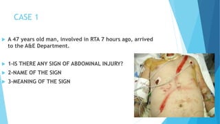 CASE 1
 A 47 years old man, involved in RTA 7 hours ago, arrived
to the A&E Department.
 1-IS THERE ANY SIGN OF ABDOMINAL INJURY?
 2-NAME OF THE SIGN
 3-MEANING OF THE SIGN
 